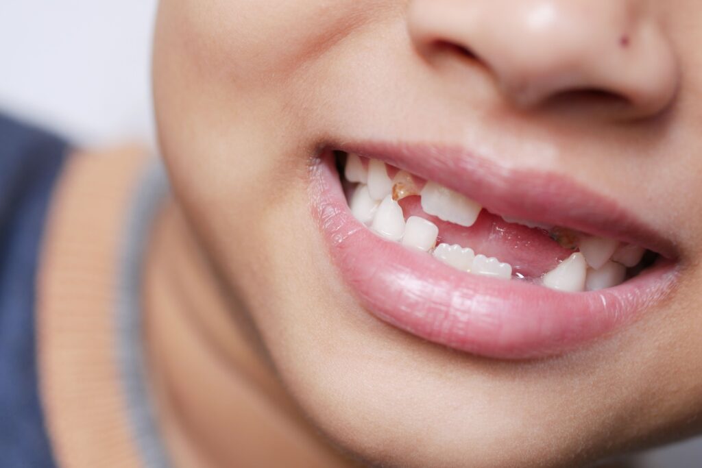 Missing teeth replacement at MK Dental Studio in Fulshear, TX