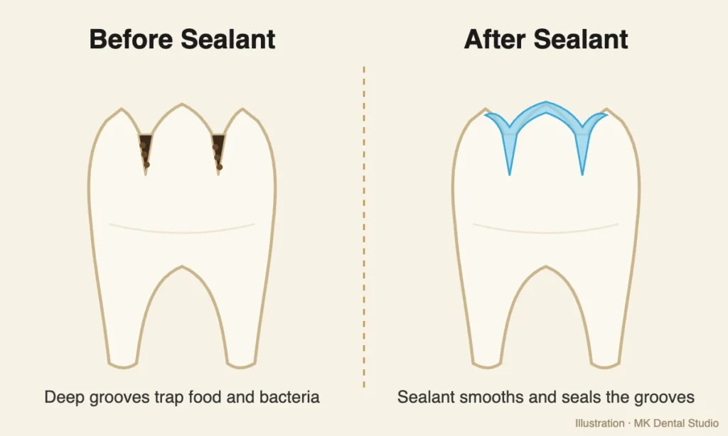 Illustration of a molar before and after a dental sealant at MK Dental Studio in Fulshear, TX
