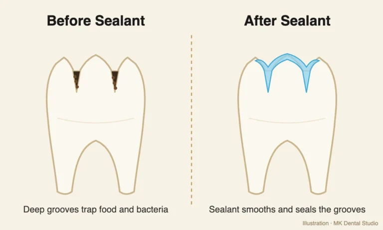 Illustration of a molar before and after a dental sealant at MK Dental Studio in Fulshear, TX