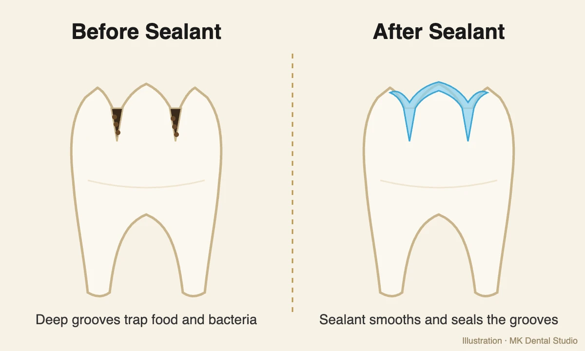 Illustration of a molar before and after a dental sealant at MK Dental Studio in Fulshear, TX